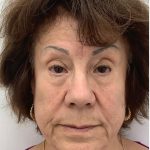 Full Face Enhancement (Botox + Filler Treatment) Before & After Patient #3600