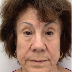 Full Face Enhancement (Botox + Filler Treatment) Before & After Patient #3600