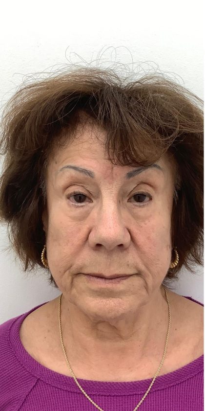 Full Face Enhancement (Botox + Filler Treatment) Before & After Patient #3600