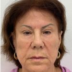 Full Face Enhancement (Botox + Filler Treatment) Before & After Patient #3600
