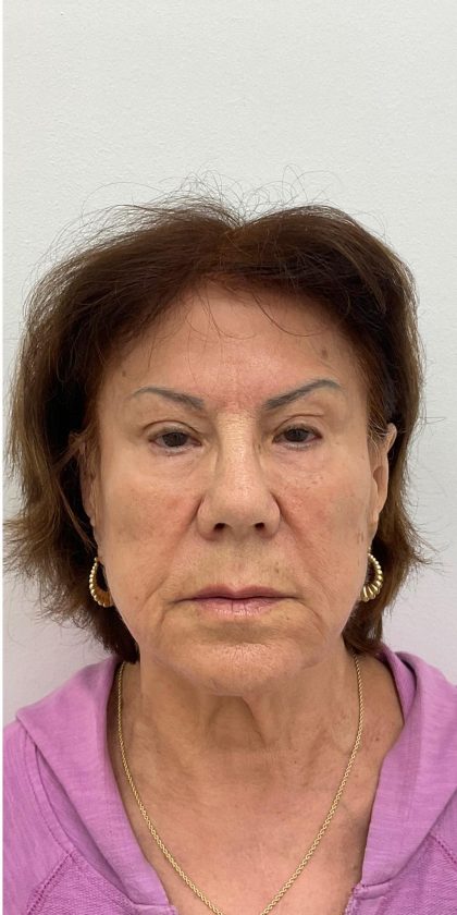 Full Face Enhancement (Botox + Filler Treatment) Before & After Patient #3600