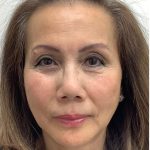 Facial Fillers Before & After Patient #3622
