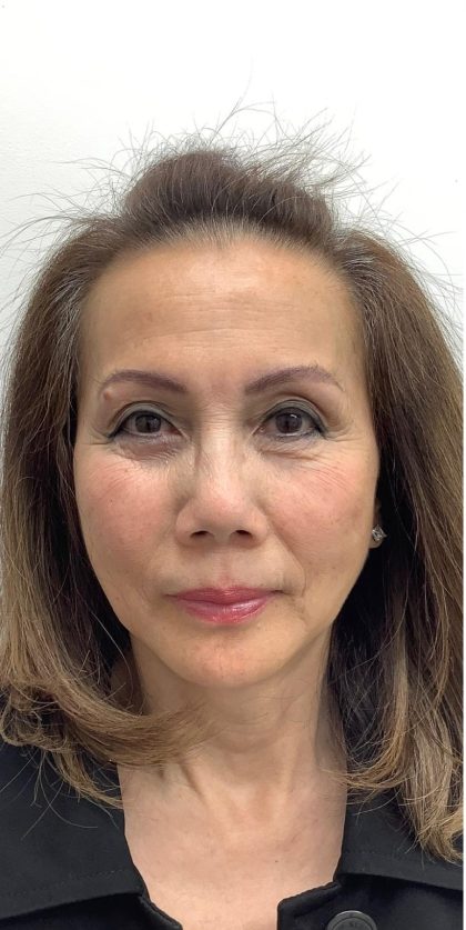Facial Fillers Before & After Patient #3622