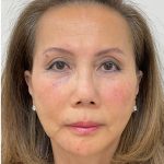 Facial Fillers Before & After Patient #3622