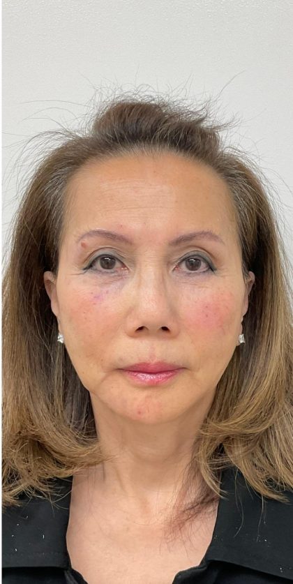 Facial Fillers Before & After Patient #3622