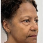 Lower Blepharoplasty Before & After Patient #3604
