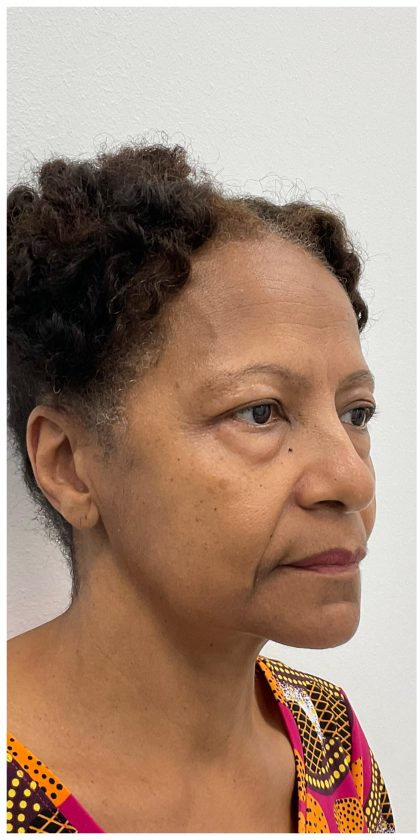 Lower Blepharoplasty Before & After Patient #3604