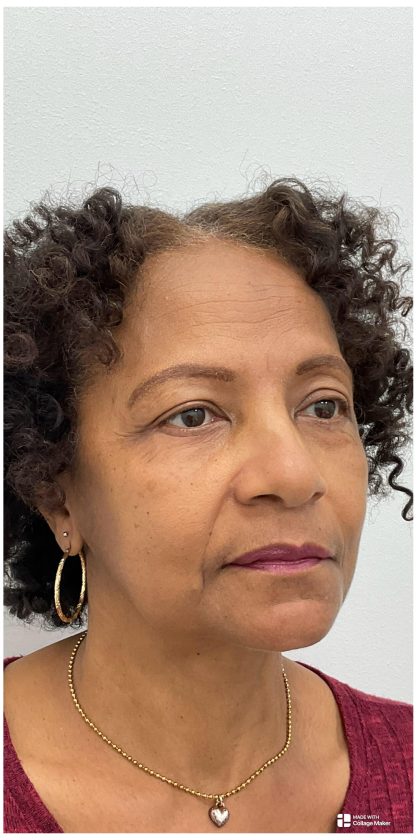 Lower Blepharoplasty Before & After Patient #3604