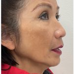 Full Face Enhancement (Botox + Filler Treatment) Before & After Patient #3631