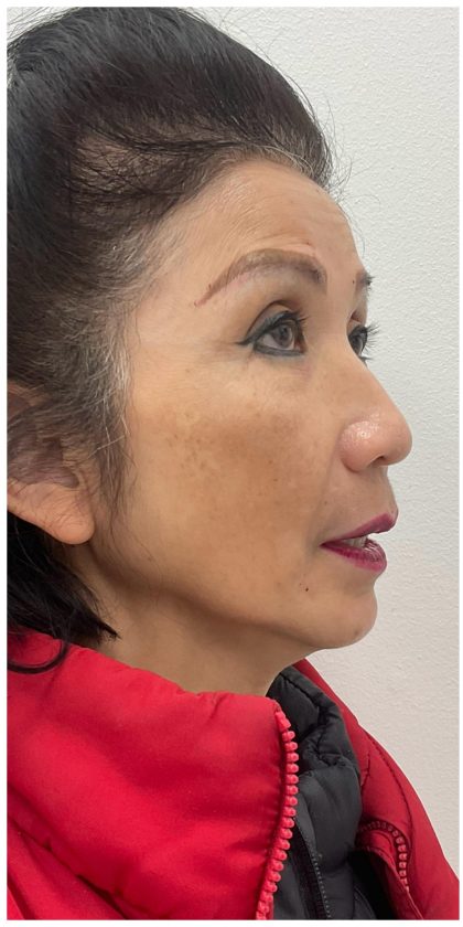 Full Face Enhancement (Botox + Filler Treatment) Before & After Patient #3631