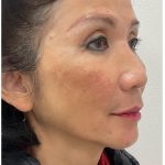 Full Face Enhancement (Botox + Filler Treatment) Before & After Patient #3631