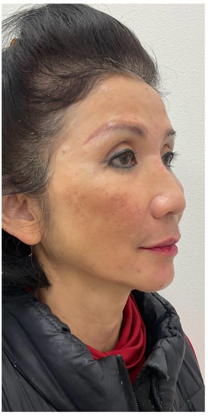 Full Face Enhancement (Botox + Filler Treatment) Before & After Patient #3631