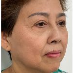 Facial Fillers Before & After Patient #3603