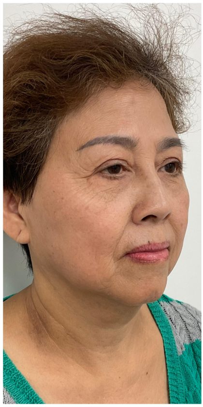 Facial Fillers Before & After Patient #3603