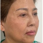 Facial Fillers Before & After Patient #3603
