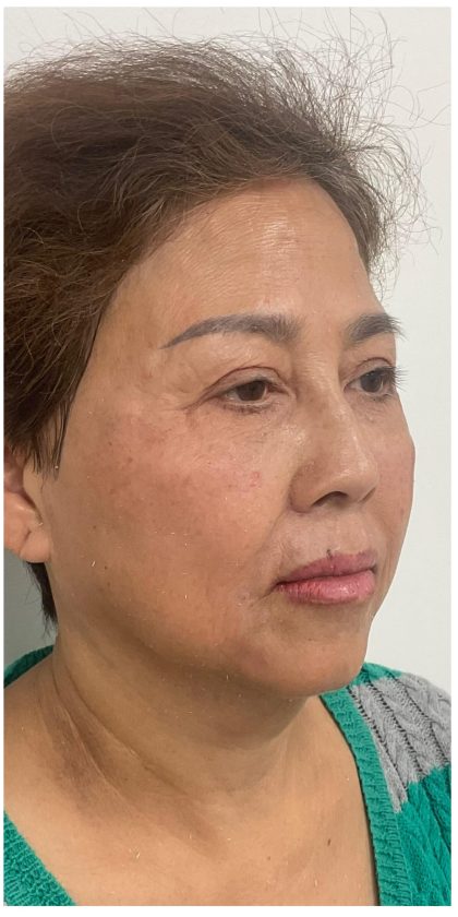 Facial Fillers Before & After Patient #3603