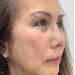 Facial Fillers Before & After Patient #3622