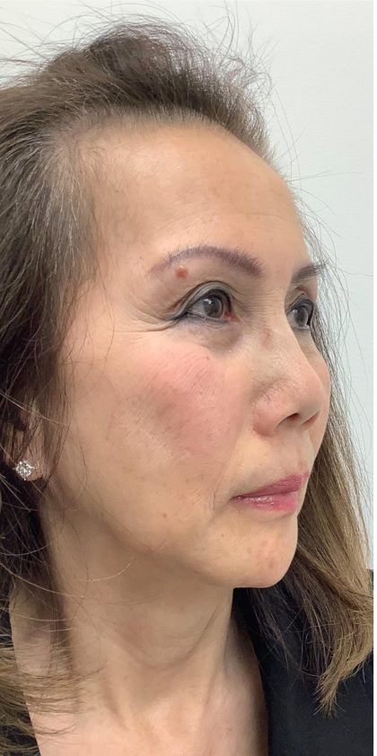 Facial Fillers Before & After Patient #3622