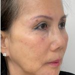 Facial Fillers Before & After Patient #3622