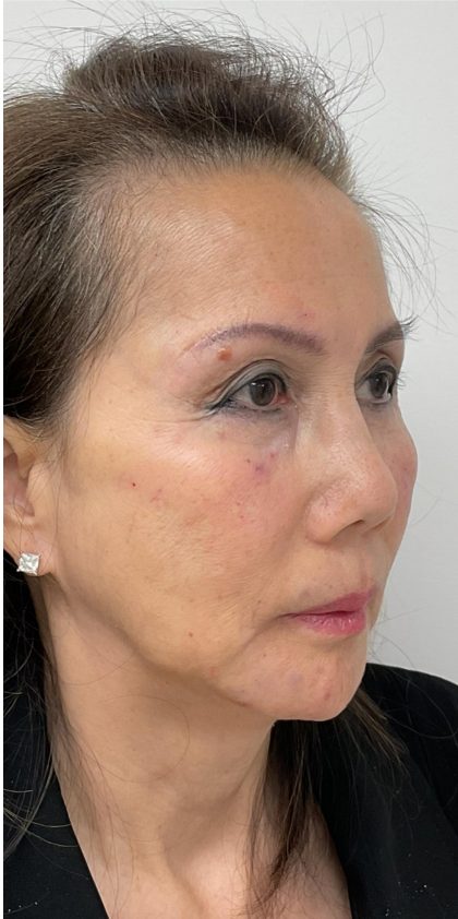 Facial Fillers Before & After Patient #3622