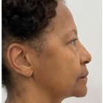 Lower Blepharoplasty Before & After Patient #3604