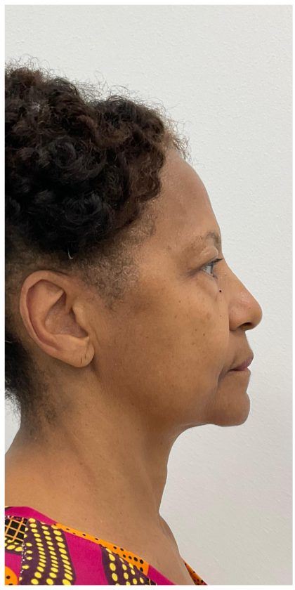 Lower Blepharoplasty Before & After Patient #3604