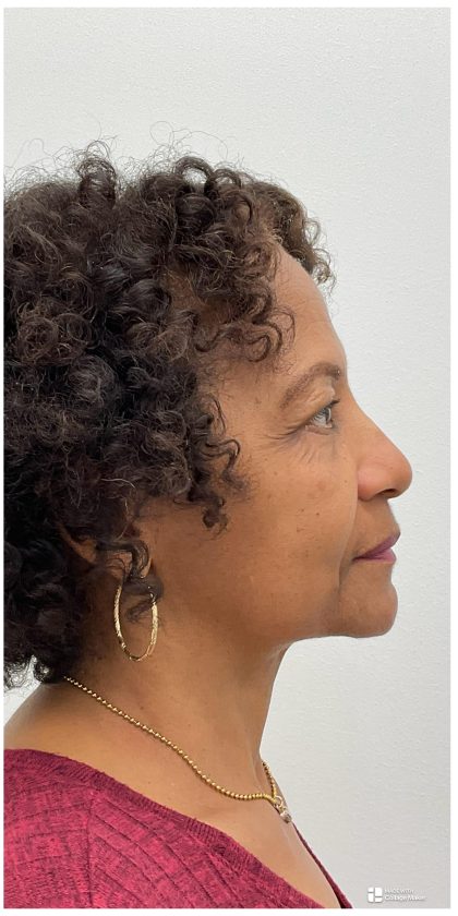 Lower Blepharoplasty Before & After Patient #3604