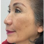 Full Face Enhancement (Botox + Filler Treatment) Before & After Patient #3631