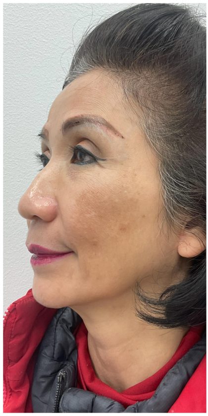 Full Face Enhancement (Botox + Filler Treatment) Before & After Patient #3631