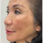 Full Face Enhancement (Botox + Filler Treatment) Before & After Patient #3631
