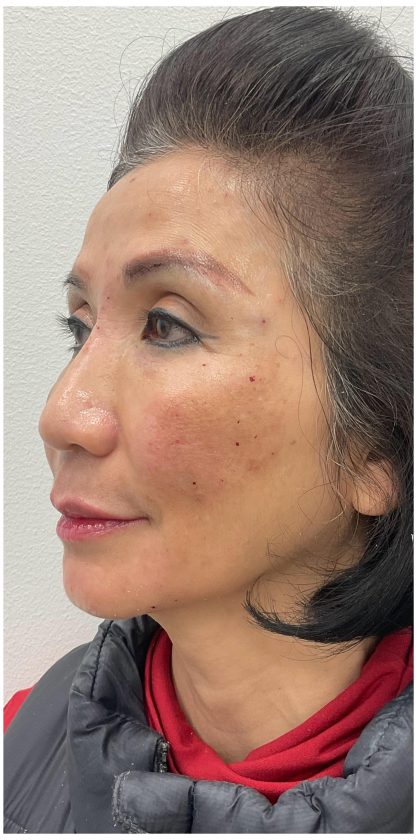 Full Face Enhancement (Botox + Filler Treatment) Before & After Patient #3631