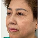 Facial Fillers Before & After Patient #3603