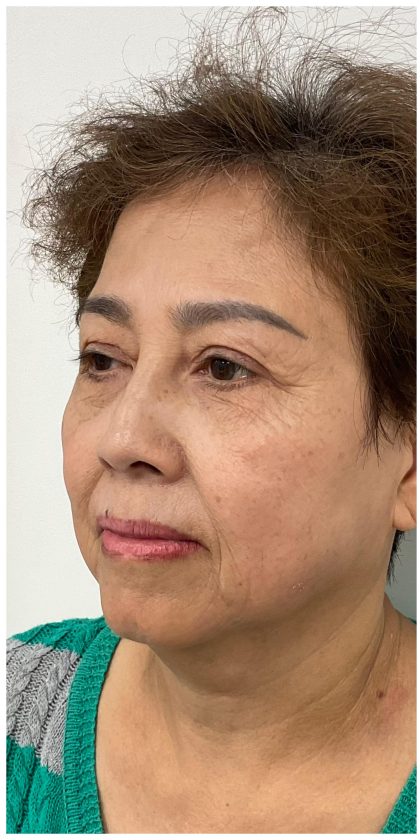 Facial Fillers Before & After Patient #3603