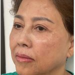 Facial Fillers Before & After Patient #3603