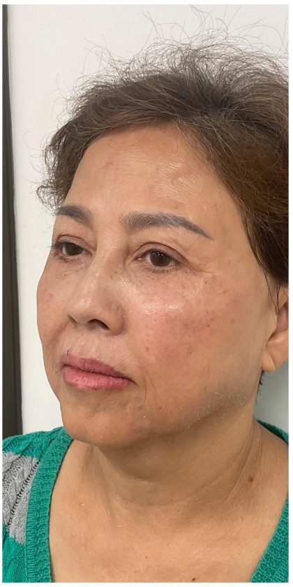 Facial Fillers Before & After Patient #3603