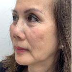 Facial Fillers Before & After Patient #3622