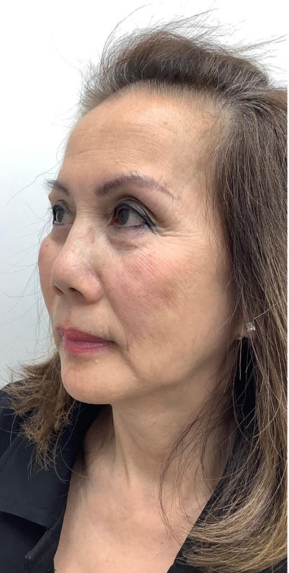 Facial Fillers Before & After Patient #3622