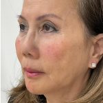Facial Fillers Before & After Patient #3622