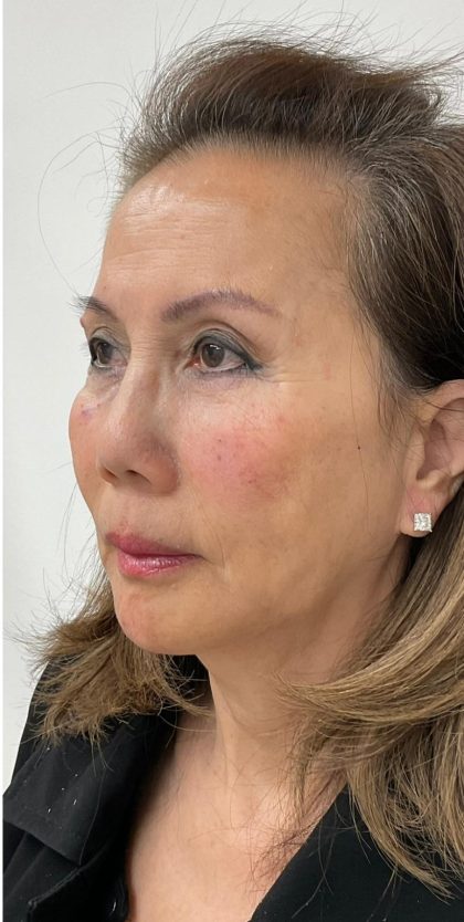 Facial Fillers Before & After Patient #3622
