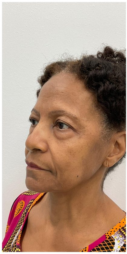 Lower Blepharoplasty Before & After Patient #3604