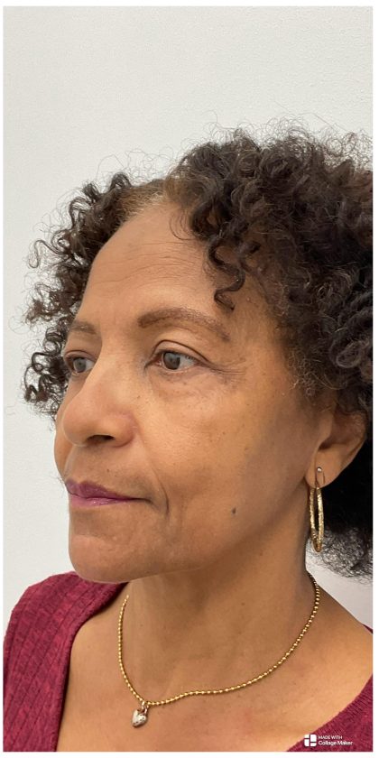 Lower Blepharoplasty Before & After Patient #3604