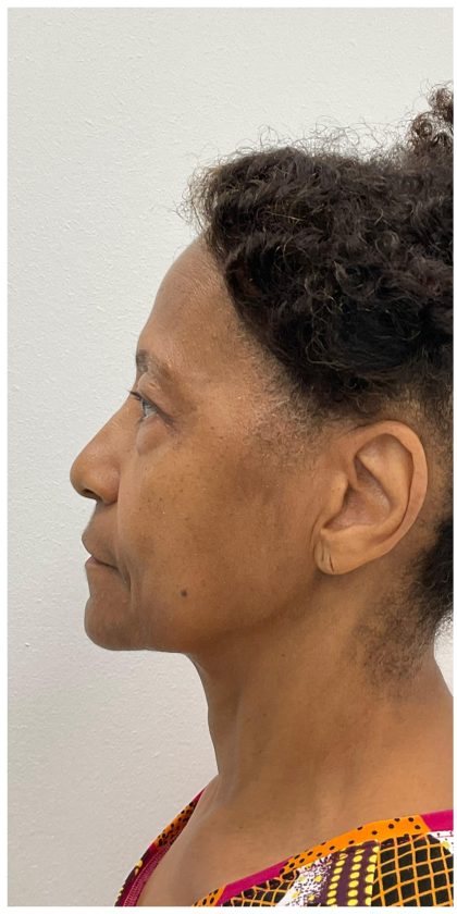 Lower Blepharoplasty Before & After Patient #3604