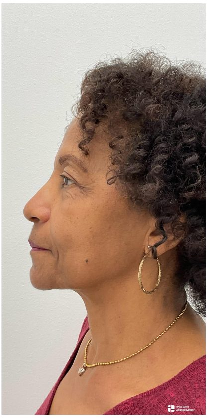Lower Blepharoplasty Before & After Patient #3604
