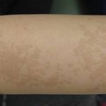 Nouvaderm Before & After Patient #3692
