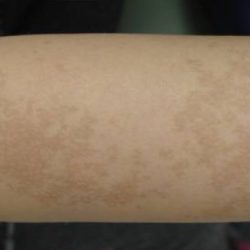 Nouvaderm Before & After Patient #3692