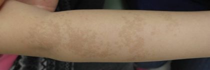Nouvaderm Before & After Patient #3692