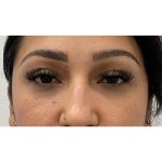 Under Eye Fillers Before & After Patient #3664