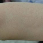 Nouvaderm Before & After Patient #3692