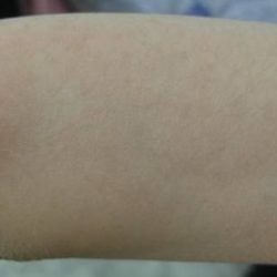 Nouvaderm Before & After Patient #3692