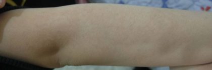 Nouvaderm Before & After Patient #3692